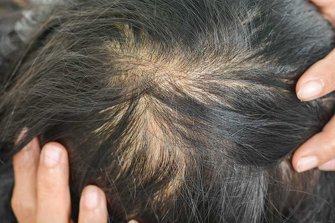 Low dose MINOXIDIL for hair thinning - what you need to know