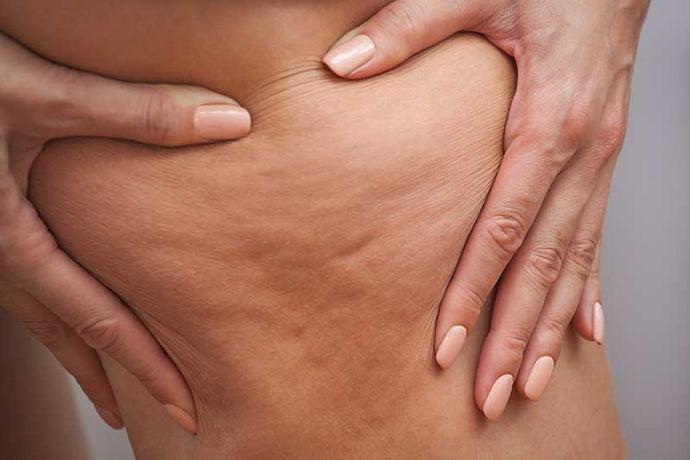 What can I do about cellulite? What is AVELI?